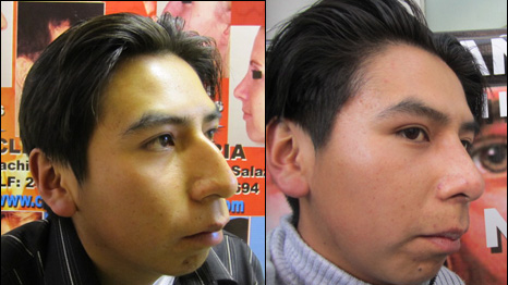 Juan Carlos before and after surgery