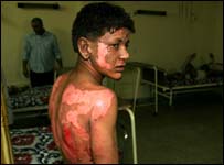 Vítima de explosão no Iraque