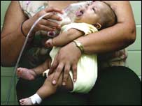 Criança recebe inalação na Guatemala