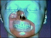 चेहरा प्रतिरोपण