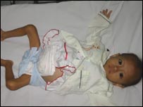 Trẻ em nhiễm HIV/AIDS bị bỏ rơi