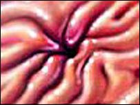 معدے کا السر