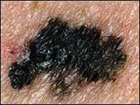 نمونه ای از سرطان ملانوما