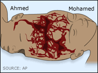 एक नस थी जो दोनों के बीच एक थी
