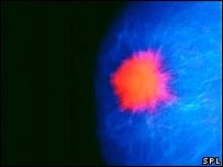 چھاتیوں کا  کینسر