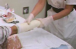 A nurse applys a plaster cast to a broken arm