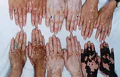 Hands with people of vitiligo