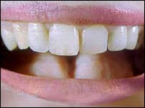 साफ़ दाँत और मुस्कुराहट का रिश्ता