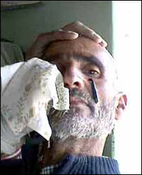 جونکوں کے ذریعہ علاج کرتا مریض