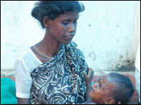 غذائیت کی کمی کا شکار بچہ