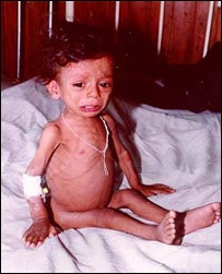 کودک مصاب به سو تغذی