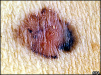 melanoma