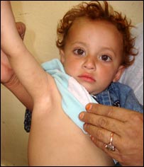 يوه  ماشومه چې د شری په مرض اخته دی