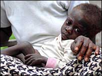 Child with HIV