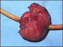 Próstata com câncer