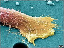 ung thư tuyến tiền liệt