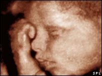 Ultra-sonografia em 3D