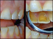 दाँत-असली या नक़ली?