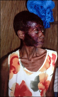 Portadora do vírus em Moçambique