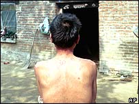 Một bệnh nhân AIDS