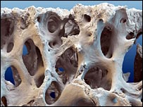 Osso afetado pela osteoporose