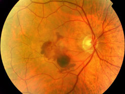 An eye suffering from age-related macular degeneration
