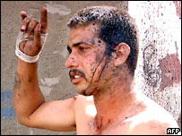 سمارا میں زخمی ہونے والا ایک عراقی