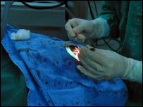 Transplante de córnea no Hospital Universitário de Brasília. Foto: Elza Fiúza/ABr 