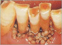 Gum infection with fly larvae