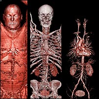 Imagem do scanner (Siemens)