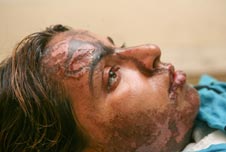 Acid attack victim, Shama
