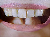 भरे दाँतों की मुस्कुराहट