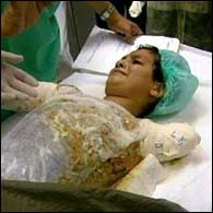 Ali Abbas-Iraqi boy who had his arms blown off