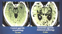 Changes in the Brain in AD