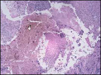 نمونه ای از سرطان پوست