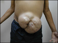 چره در مردان