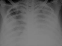 Radiografia de pulmão