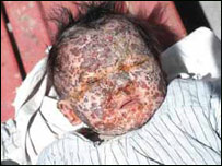 مبتلابه ملاريا