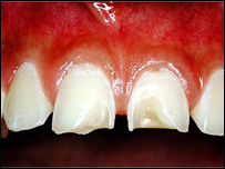 نوعی از آفت دندان 