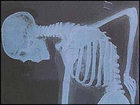 पीठ का दर्द