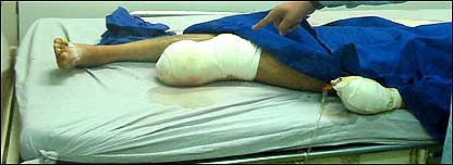 پشاور میں زیرِ علاج سید ولی محمد جو مدرسے پر بمباری کے باعث ایک ٹانگ سے محروم ہوگئے