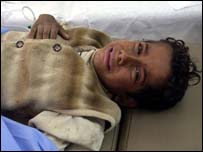 Menino iraquiano atingido por bombardeio americano se recupera em hospital de Falluja. Seu pai morreu no ataque durante este fim-de-semana