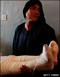 پاهای باندپیچی شده یک قربانی خودسوزی، در دستان مادرش، در بیمارستان هرات