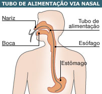 Tubo de alimentação nasal