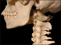 مشکل مهره های گردن