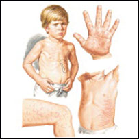 تب روماتيزم