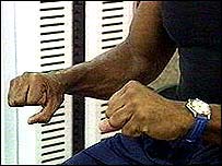 पाक्रिन्संस का एक मरीज़