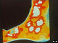 روبہ صحت السر کا حرارتی عکس