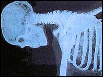 रीढ़ की हड़्डी