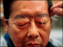  آکوپنکچراور برقی لہروں  کا استعمال 